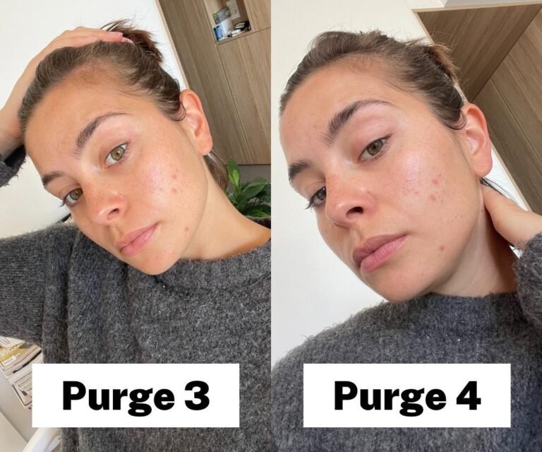 Understanding the Tretinoin Purge Timeline: What’s Normal and How to Manage It